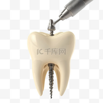 用钻头清理蛀牙的3d插图