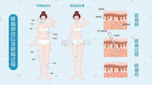 女生医美插画图片_医美整容整形吸脂减肥科普