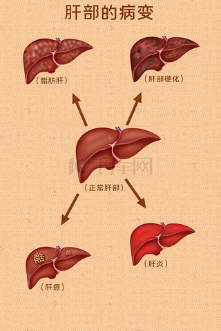 人体医疗组织器官肝病变插画科普科普