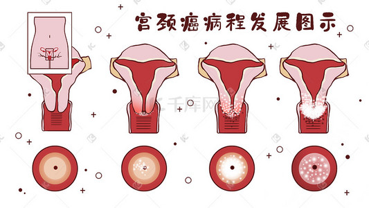 组织组织插画图片_医疗人体组织器官宫颈癌插画科普