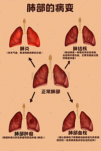 肺部影像插画图片_人体医疗组织器官人体肺部病变插画科普