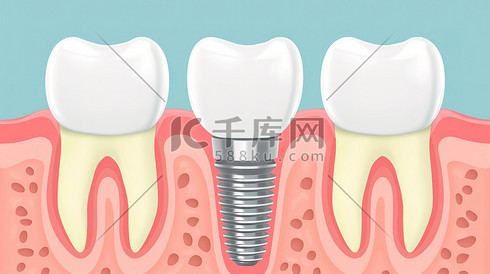 种植牙特写平面插画