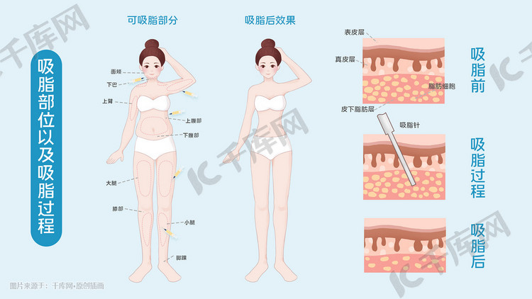 医美整容整形吸脂减肥科普