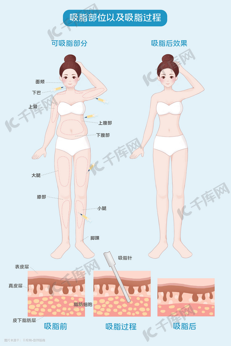 医美整容整形吸脂减肥科普