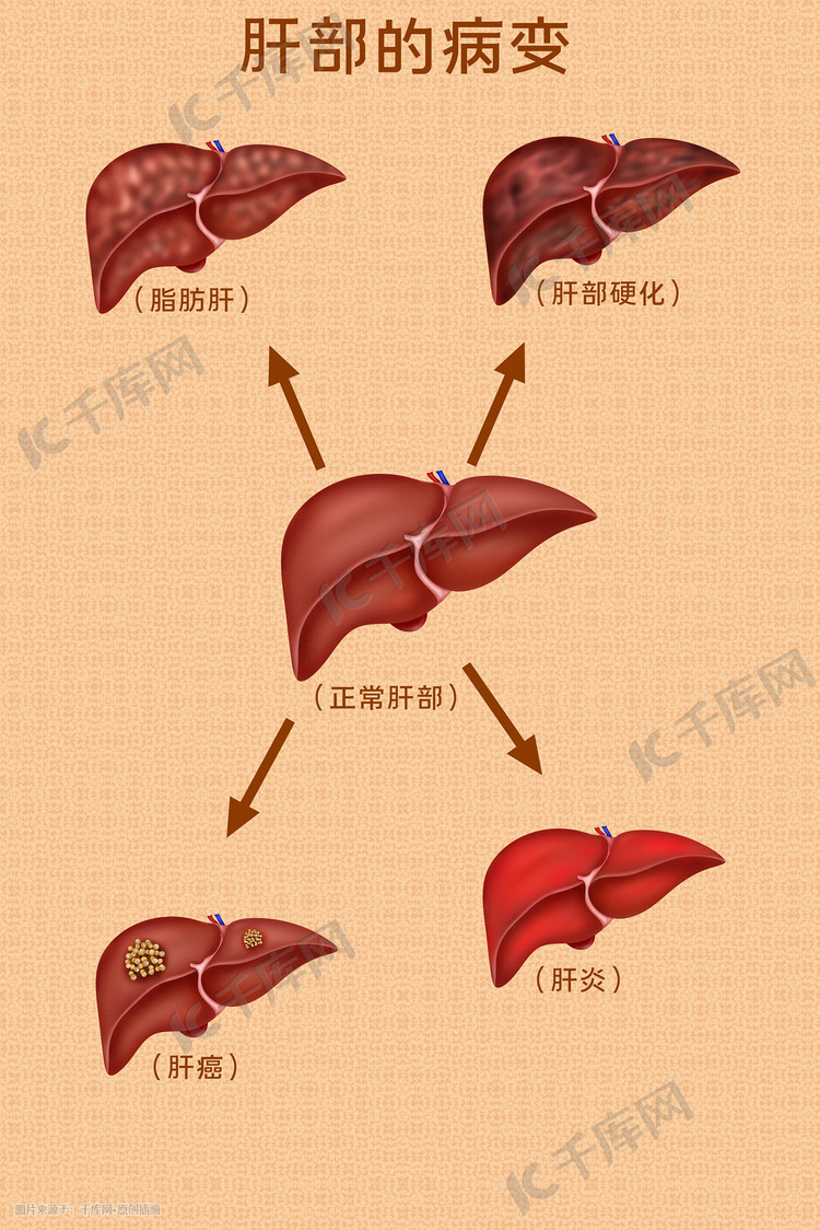 人体医疗组织器官肝病变插画科普科普