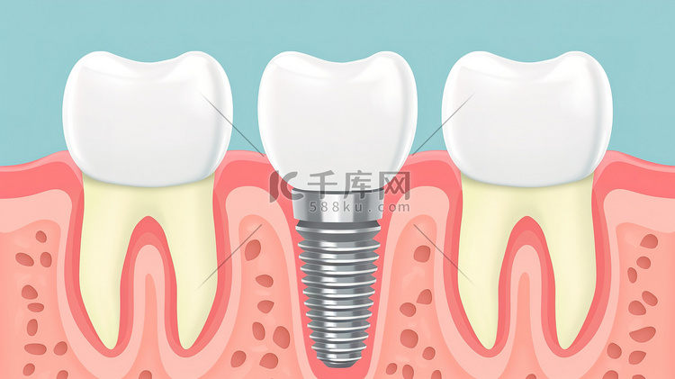 种植牙特写平面插画