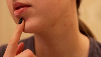 女孩看自己坏皮肤脖子痘肌