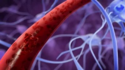 3d版实拍视频素材凝血和血管闭塞3D渲染医疗人体